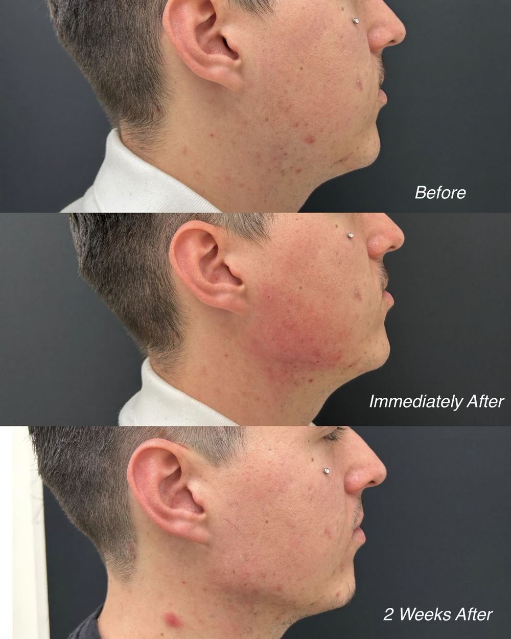 Jawline filler, before and after, patient of Dr. Parsa Rajabi