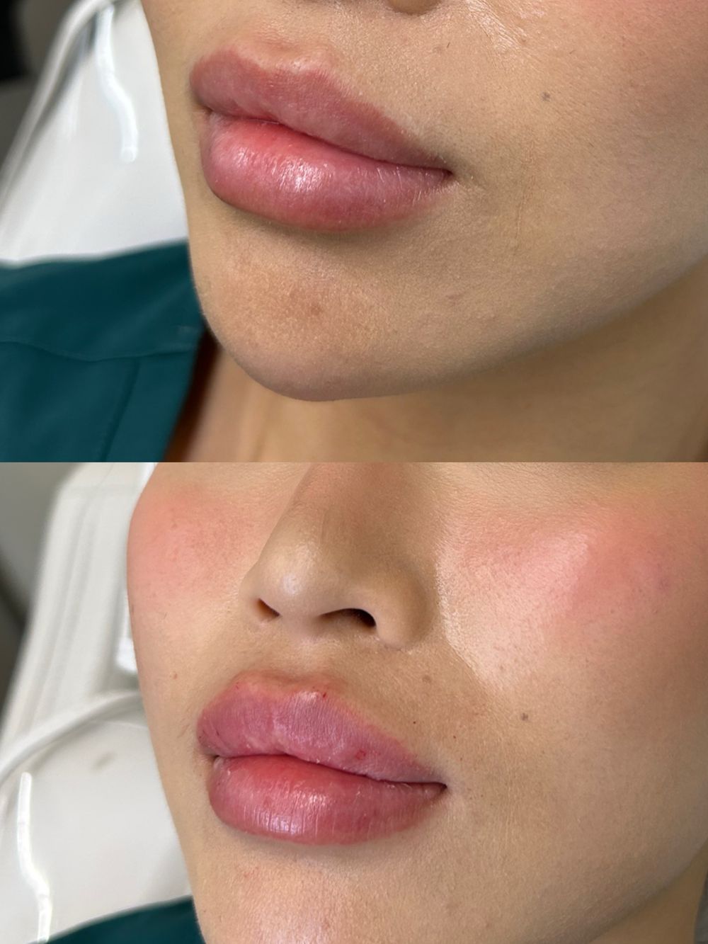 Lip filler, before and after, patient of Dr. Parsa Rajabi