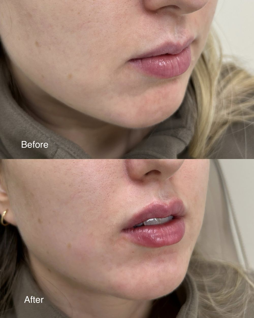 Lip filler, before and after, patient of Dr. Parsa Rajabi