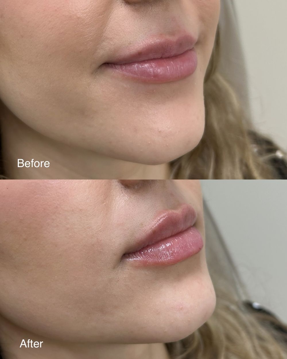 Lip filler, before and after, patient of Dr. Parsa Rajabi