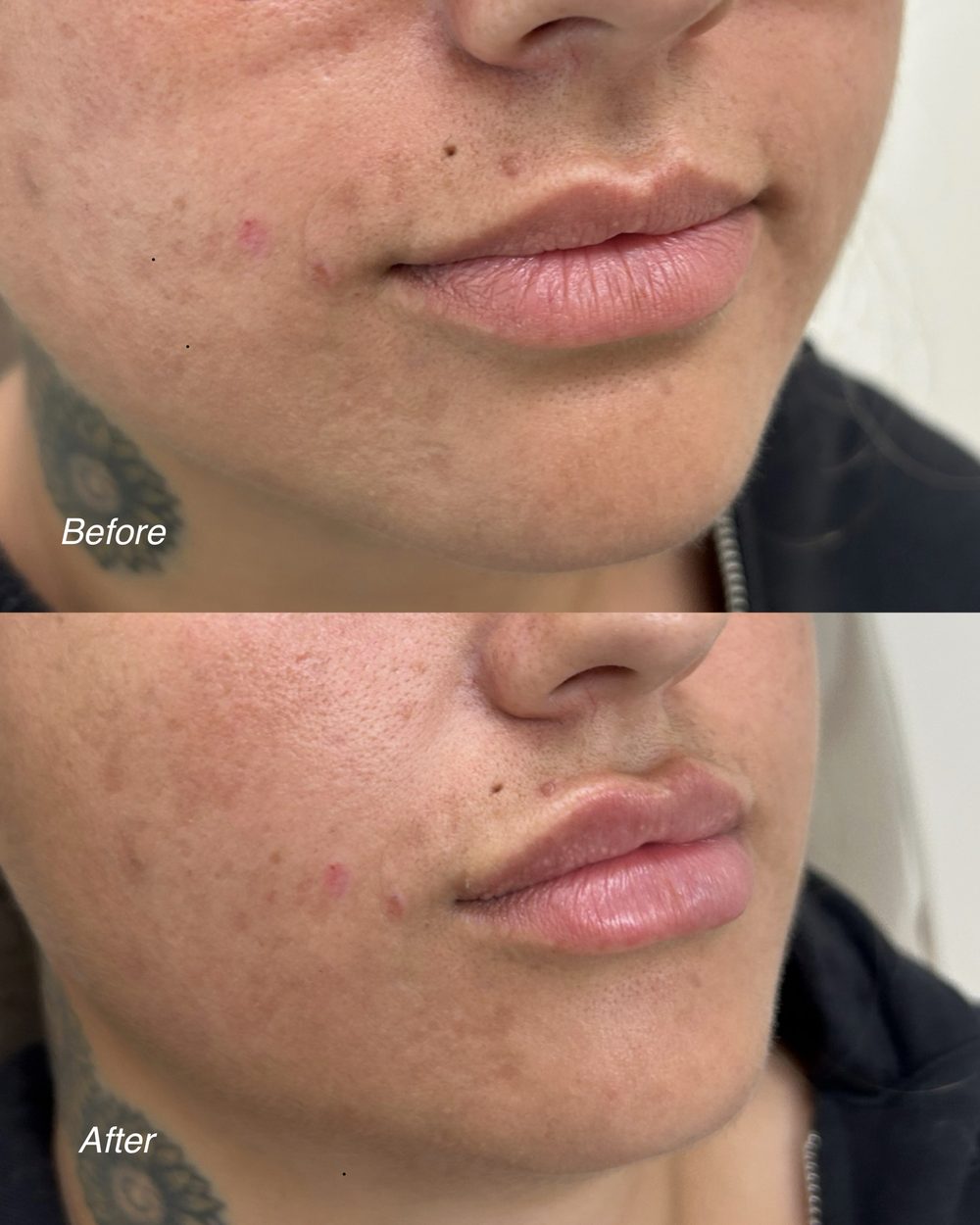 Lip filler, before and after, patient of Dr. Parsa Rajabi