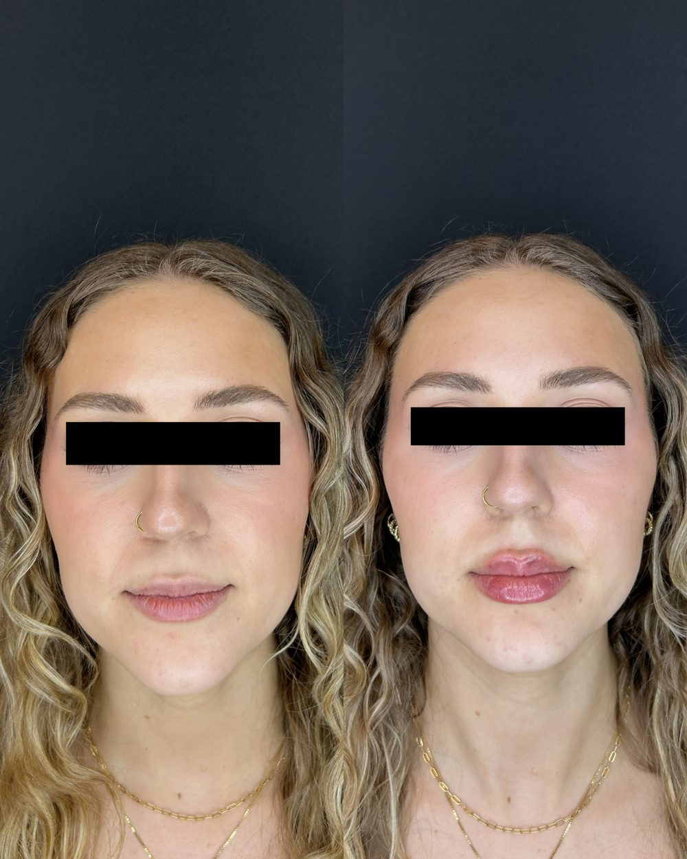 Lip filler, before and after, front view, patient of Dr. Parsa Rajabi