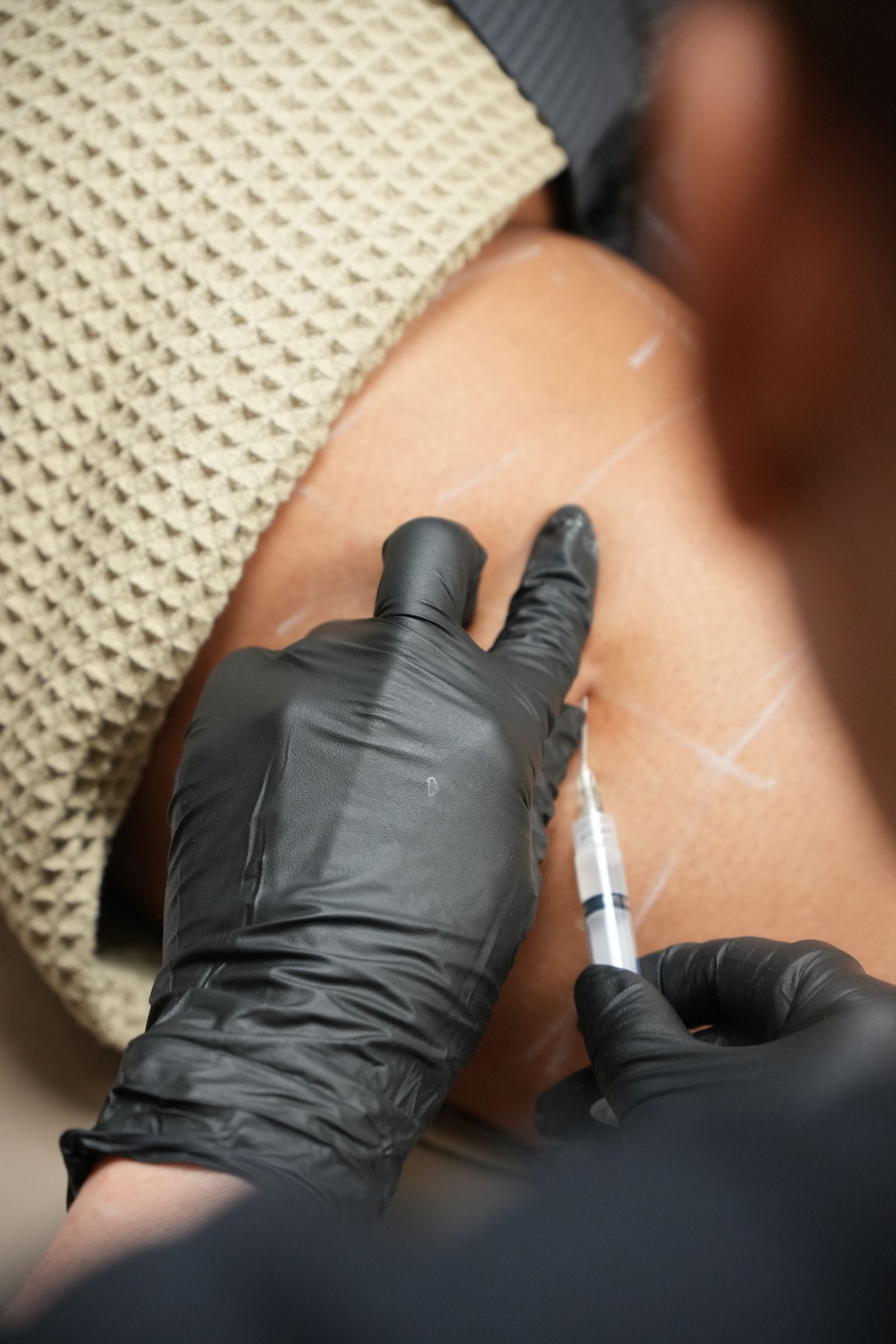 Collagen stimulator with Dr. Parsa Rajabi in Vancouver
